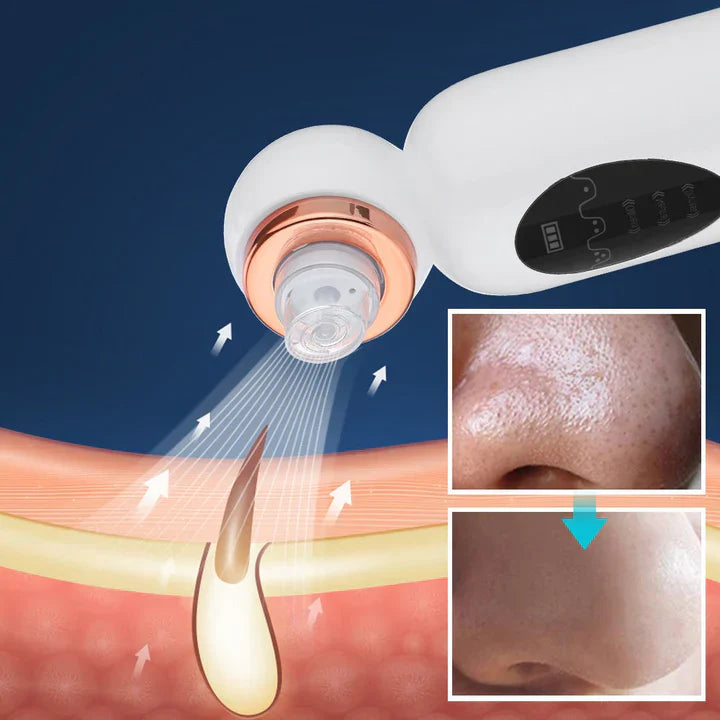 Pore Vacuum and Hydrodermabrasion Facial Device