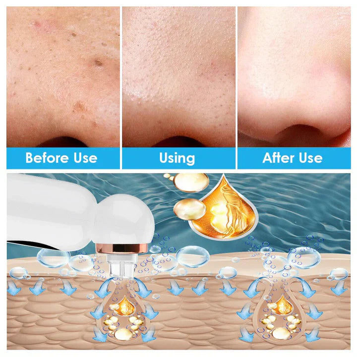 Pore Vacuum and Hydrodermabrasion Facial Device