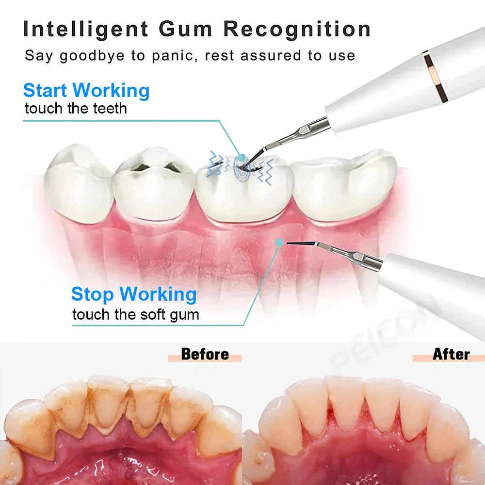 Electric Sonic Plaque Remover | SmileCare Pro