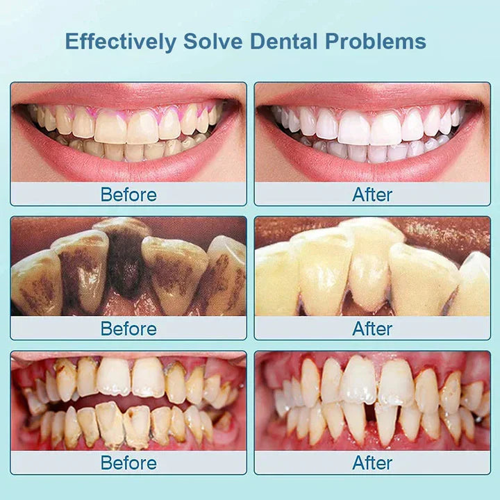 Electric Sonic Plaque Remover | SmileCare Pro