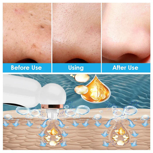 Pore Vacuum and Hydrodermabrasion Facial Device