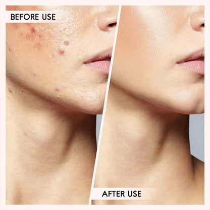 Professional Pimple & Blackhead Extractor Kit