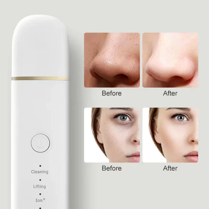 Ultrasonic Facial Skin Scrubber